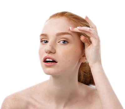 acne treatment skin care peel